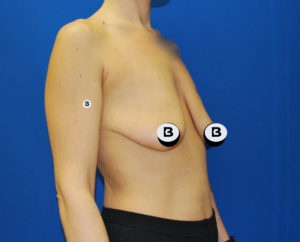 Mastopexy (Breast Lift) Before and After Pictures Buffalo, NY