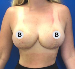 Breast Reduction Before and After Pictures Buffalo, NY