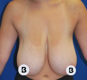 Breast Reduction Before and After Pictures Buffalo, NY