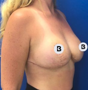 Breast Reduction Before and After Pictures Buffalo, NY