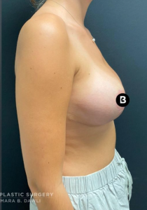 Breast Reduction Before and After Pictures in Buffalo, NY