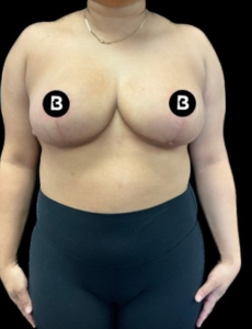 Breast Reduction Before and After Pictures in Buffalo, NY