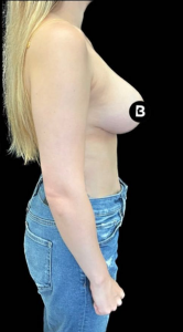 Breast Reduction Before and After Pictures in Buffalo, NY