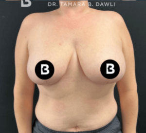 Breast Reduction Before and After Pictures in Buffalo, NY