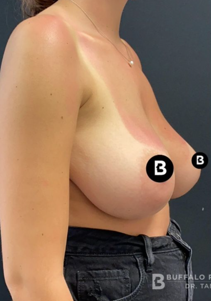 Breast Reduction Before and After Pictures in Buffalo, NY