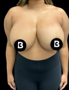 Breast Reduction Before and After Pictures in Buffalo, NY