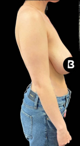 Breast Reduction Before and After Pictures in Buffalo, NY