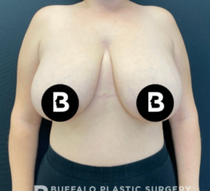 Breast Reduction Before and After Pictures in Buffalo, NY