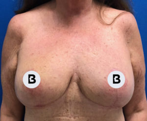 Breast Reduction Before and After Pictures Buffalo, NY