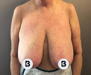 Breast Reduction Before and After Pictures Buffalo, NY