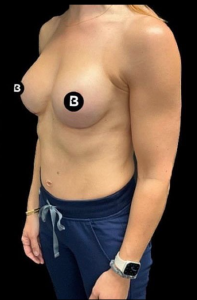 Breast Revisions Before and After Pictures in Buffalo, NY