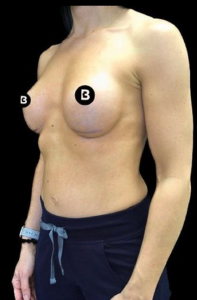 Breast Revisions Before and After Pictures in Buffalo, NY