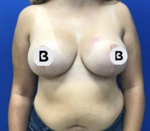 Mastopexy (Breast Lift) Before and After Pictures Buffalo, NY