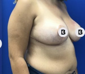 Breast Reduction Before and After Pictures Buffalo, NY
