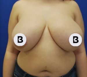 Breast Reduction Before and After Pictures Buffalo, NY