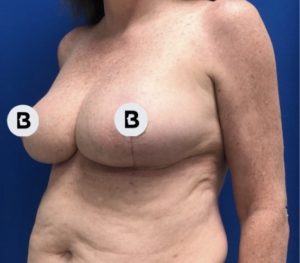 Breast Reduction Before and After Pictures Buffalo, NY
