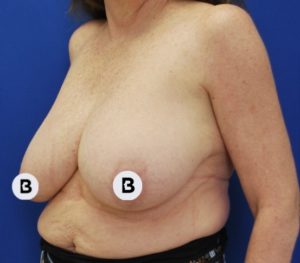 Breast Reduction Before and After Pictures Buffalo, NY
