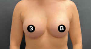 Breast Augmentation Before and After Pictures in Buffalo, NY