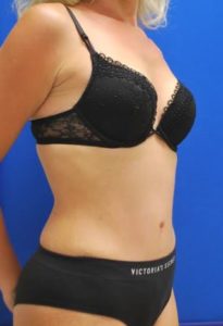 Abdominoplasty (Tummy Tuck) Before and After Pictures Buffalo, NY