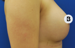 Breast Augmentation Before and After Pictures Buffalo, NY