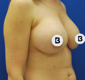 Breast Augmentation Before and After Pictures Buffalo, NY