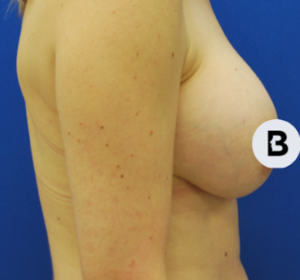 Breast Augmentation Before and After Pictures Buffalo, NY
