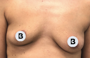 Breast Augmentation Before and After Pictures Buffalo, NY