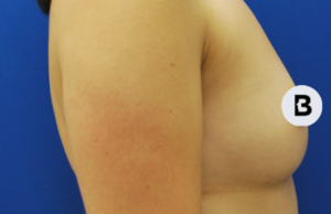 Breast Augmentation Before and After Pictures Buffalo, NY