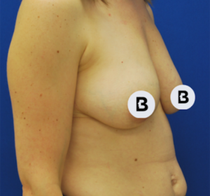Breast Augmentation Before and After Pictures Buffalo, NY