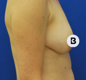 Breast Augmentation Before and After Pictures Buffalo, NY