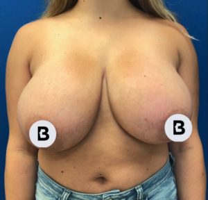 Breast Reduction Before and After Pictures Buffalo, NY