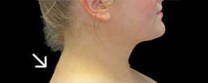 Buffalo Hump Before and After Pictures in Buffalo, NY