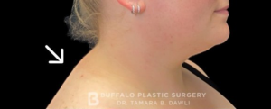 Buffalo Hump Before and After Pictures in Buffalo, NY