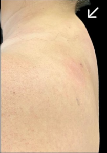 Buffalo Hump Before and After Pictures in Buffalo, NY