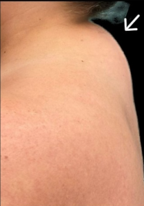 Buffalo Hump Before and After Pictures in Buffalo, NY