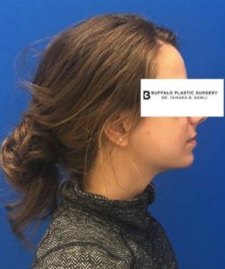 Fillers Before and After Pictures Buffalo, NY