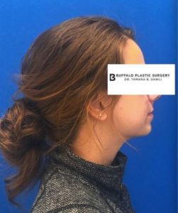 Fillers Before and After Pictures Buffalo, NY