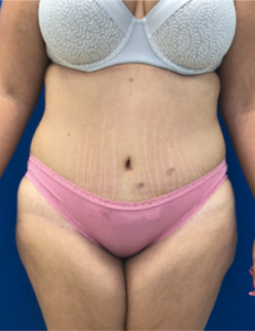 Liposuction Before and After Pictures Buffalo, NY