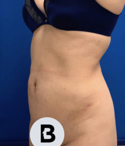 Liposuction Before and After Pictures Buffalo, NY