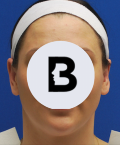 Otoplasty Before and After Pictures Buffalo, NY