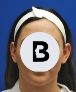 Otoplasty Before and After Pictures Buffalo, NY