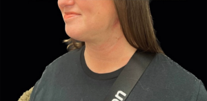Chin Liposuction Before and After Pictures Buffalo, NY