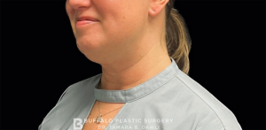 Chin Liposuction Before and After Pictures Buffalo, NY
