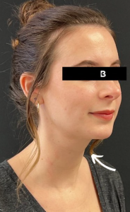 Chin Liposuction Before and After Pictures Buffalo, NY