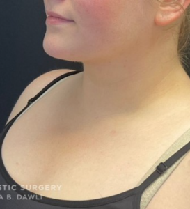 Chin Liposuction Before and After Pictures Buffalo, NY