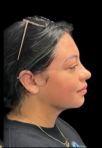 Chin Liposuction Before and After Pictures Buffalo, NY