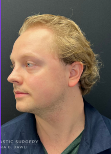 Chin Liposuction Before and After Pictures Buffalo, NY