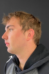 Chin Liposuction Before and After Pictures Buffalo, NY