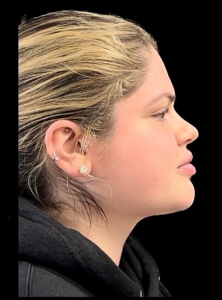Chin Liposuction Before and After Pictures Buffalo, NY