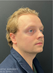 Chin Liposuction Before and After Pictures Buffalo, NY
